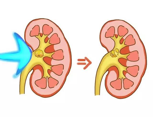 体外碎石做了三次肾结石又复发了,碎石三次了还没排出怎么回事