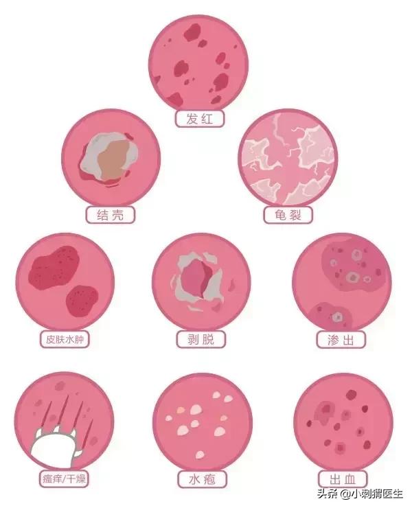 儿童湿疹科普视频,湿疹科普儿童