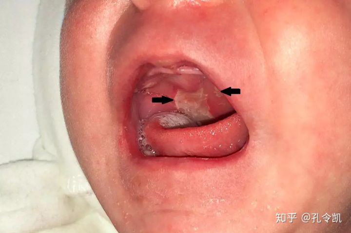 喂奶姿势不当导致孩子兜齿怎么办,宝宝喂奶姿势不对导致的口腔问题