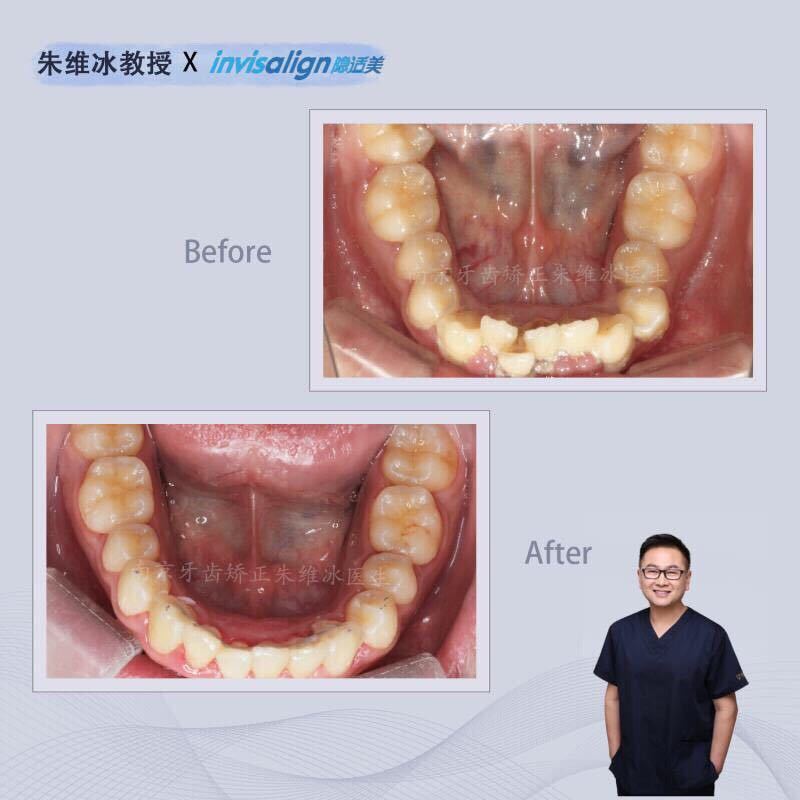 隐适美牙齿拥挤矫正真实案例,南京朱维冰