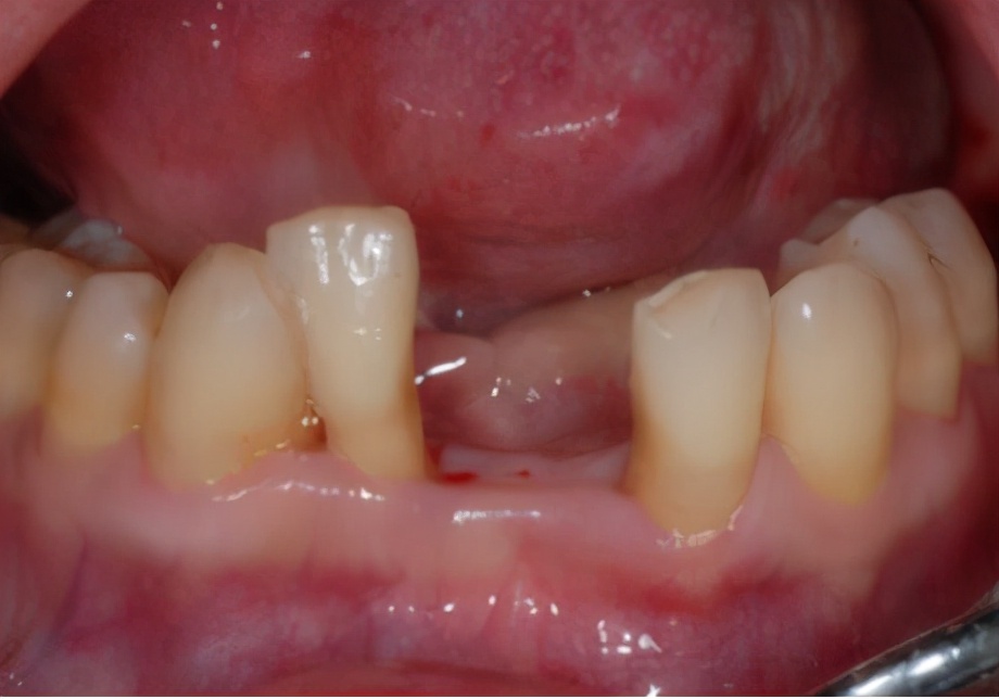 牙齿掉了不补牙可以吗,牙齿掉了不去管它有什么伤害吗
