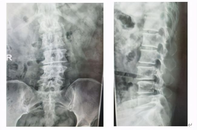 腰椎管狭窄有滑脱能做微创吗,腰椎滑脱椎管狭窄可做微创吗