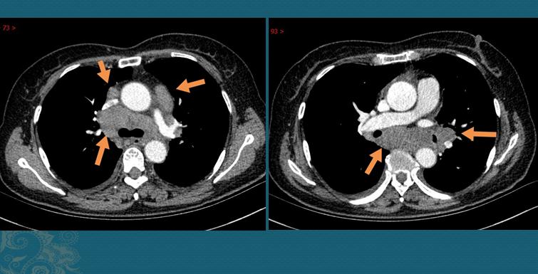 32岁肺部ct报告小结节7mm,28岁查出肺结节