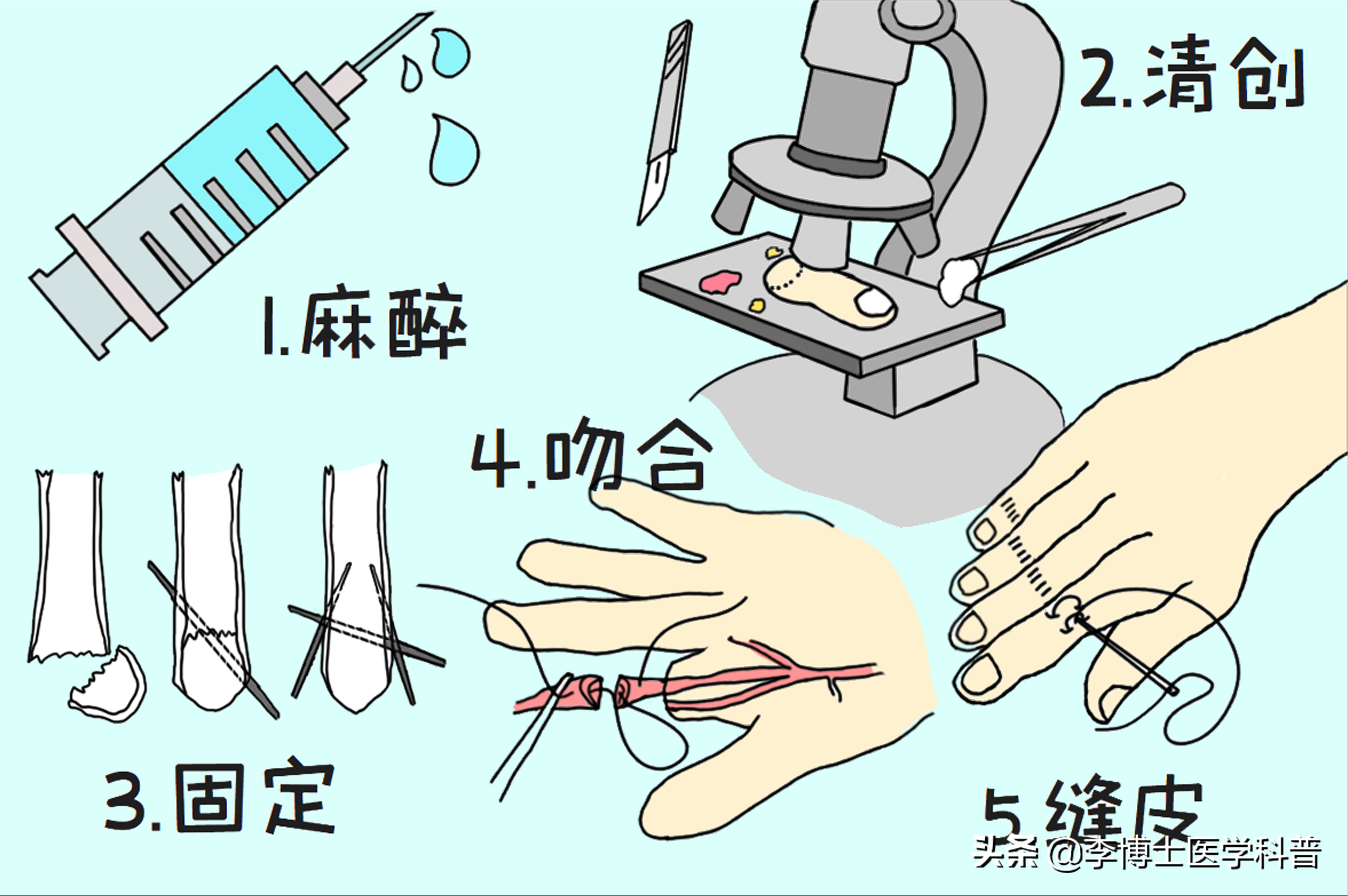 断指再植健康科普视频,断指再植技术是什么