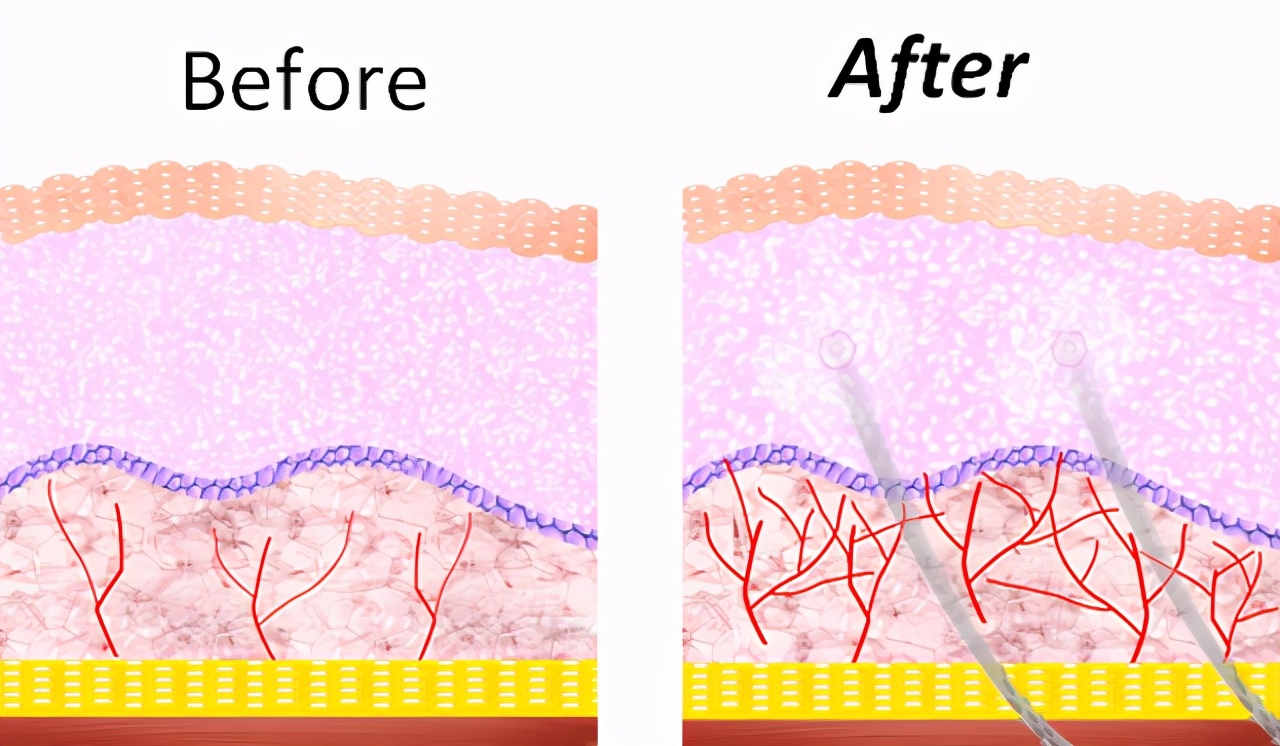 线雕吸收完了脸会变窄吗,做一次线雕代谢后会不会回到以前
