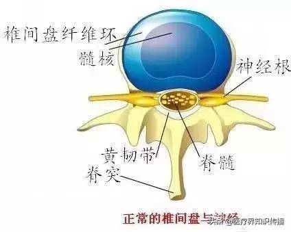 如何正确认识腰椎间盘突出症,简单两招有效缓解腰椎间盘突出症