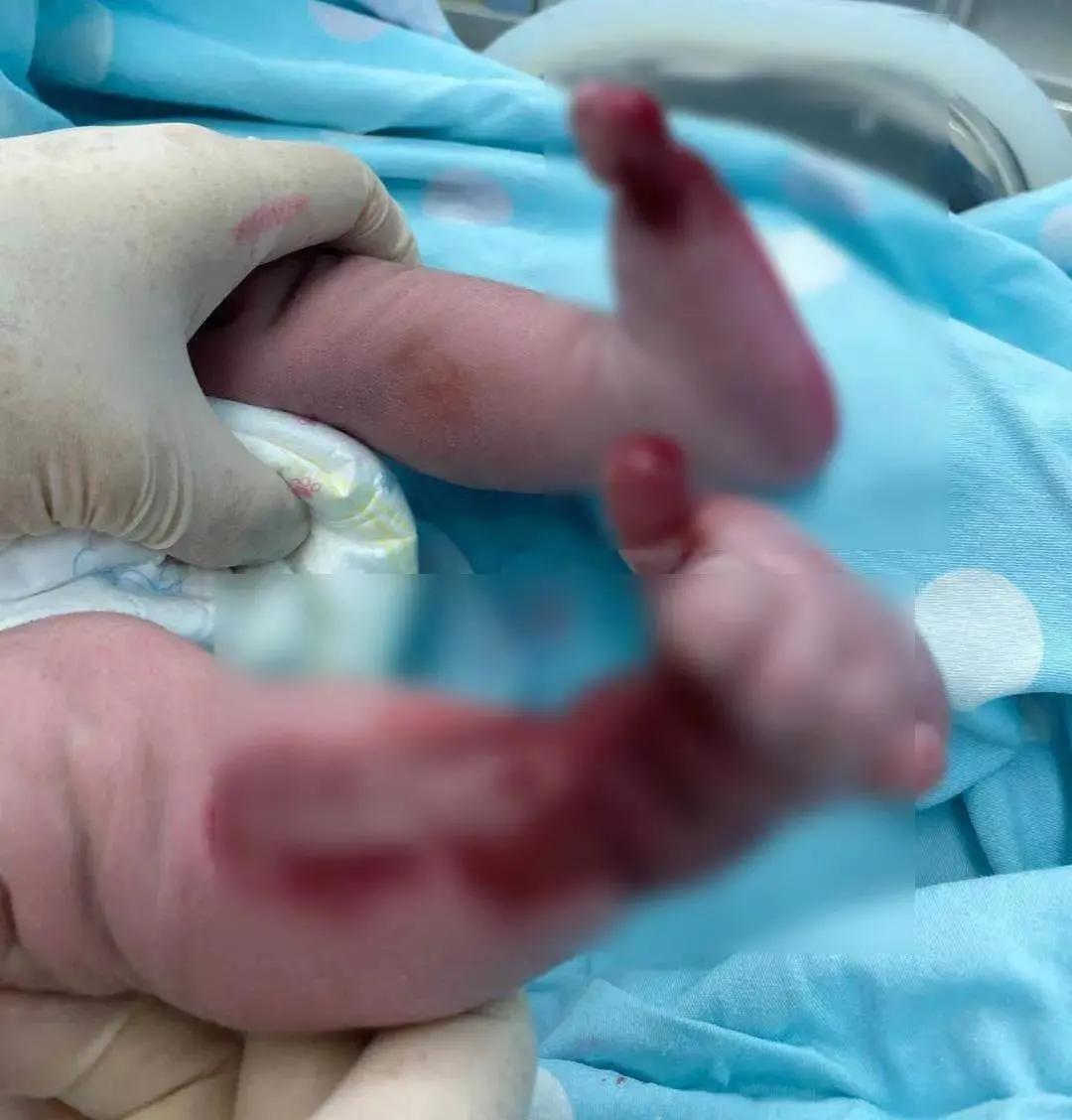 产检一路绿灯生下胎儿妈妈哭了,产检一路绿灯生下男婴却没有皮肤