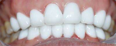 美白牙齿方法洗牙,除了洗牙怎么美白牙齿