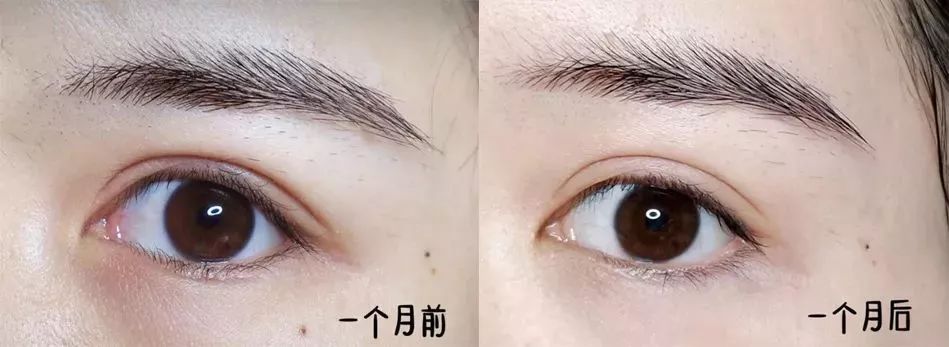 玻尿酸做眼罩方法,玻尿酸冻干眼罩