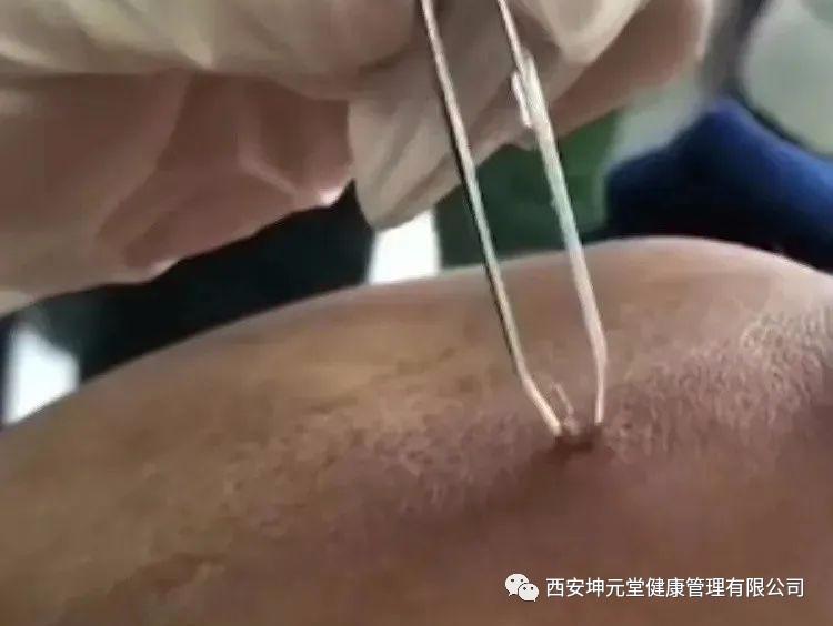 中医用截根的方法治痔疮可行吗,中医截根绝技