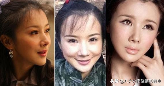 为什么注射玻尿酸会淤青,玻尿酸僵尸脸