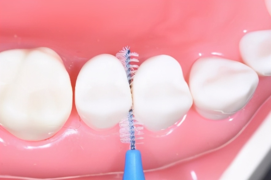 牙周病真实事件,牙周病危害大吗