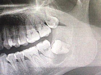 颌骨空洞是肿瘤吗,牙根部发现有个黑洞