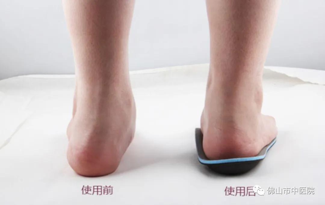 儿童扁平足的矫正训练,儿童矫正扁平足的最佳锻炼方法