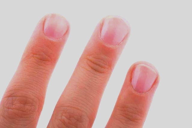 为什么得灰指甲?得了灰指甲怎么治?听医生说