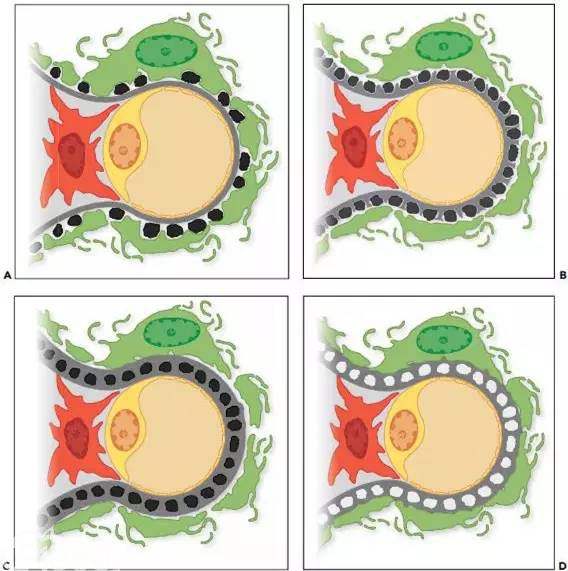 膜性肾病的尿蛋白,为何这么难消除?