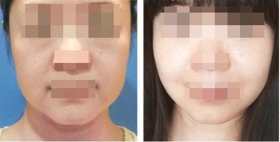 脸松弛下垂法令纹做什么医美手术,法令纹苹果肌下垂做什么手术