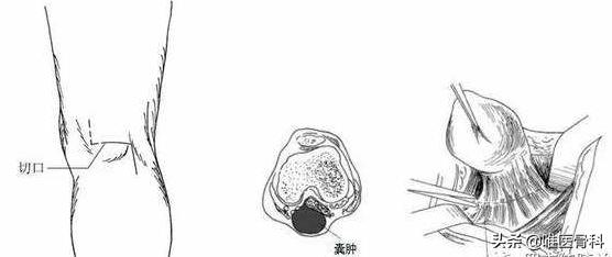 膝盖后面有个鼓鼓的包是不是病,膝盖后面有个包怎么回事