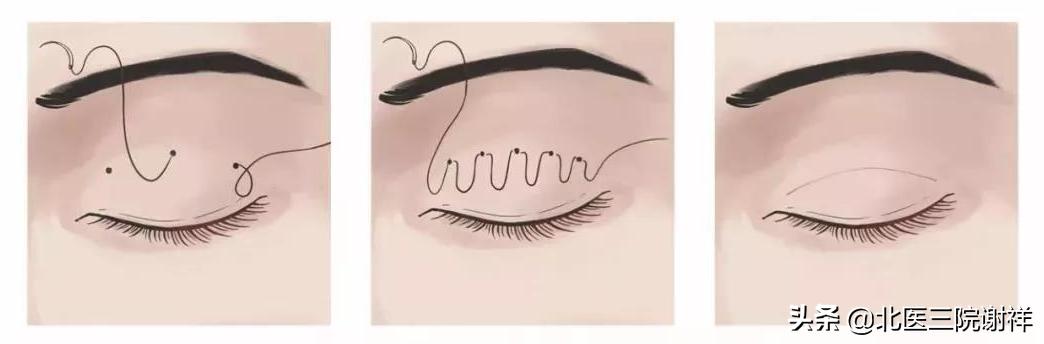 双眼皮长成内双了是怎么回事,双眼皮变成肉条的原因