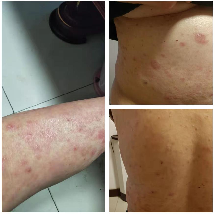 门诊案例｜30年银屑病，跑遍大街小巷却治不好？真相在这里