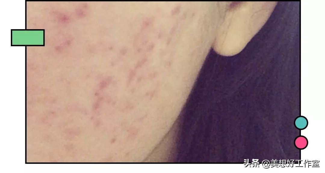 怎么祛痘印最有效简单方法,如何快速祛痘印最有效的方法