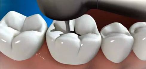 补牙最详细的过程来了，你还会看不懂吗？