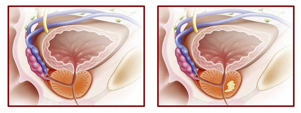 尿急尿频经常反复,经常尿急尿频是结石一直没下来吗