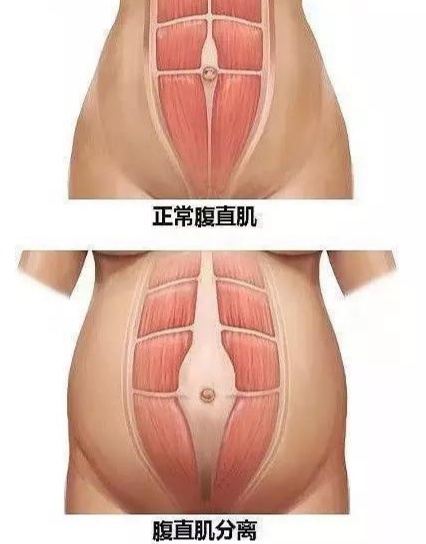 剖腹产后收腹带会影响恢复吗,剖腹产后怎么合理用收腹带