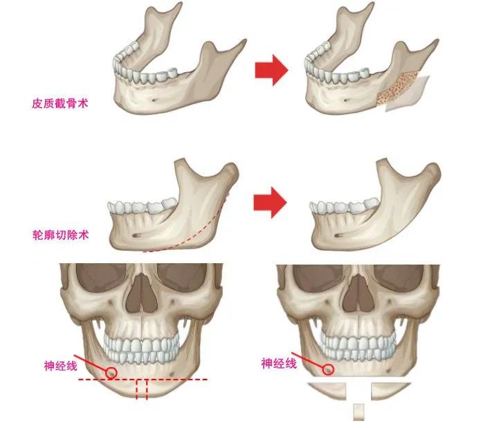 大小脸磨骨改脸型一般花费是多少,磨骨改脸型要多少钱有什么风险