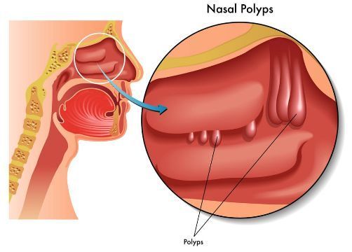 鼻息肉新药美泊利单抗,第4个适应症获美FDA受理