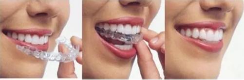 想整牙害怕有牙套脸,想整牙又害怕