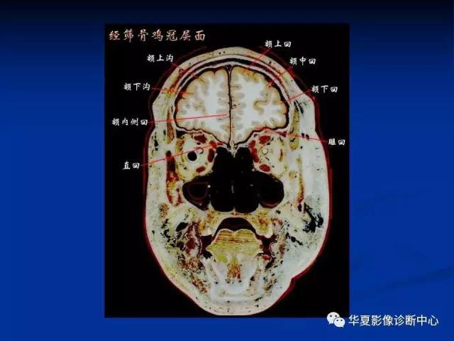 电子版头颅ct与mri断层解剖,头颅mri血管解剖与分段详解