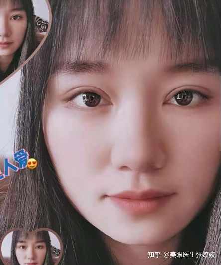 贴了双眼皮贴后的真实效果,贴双眼皮贴容易起翘