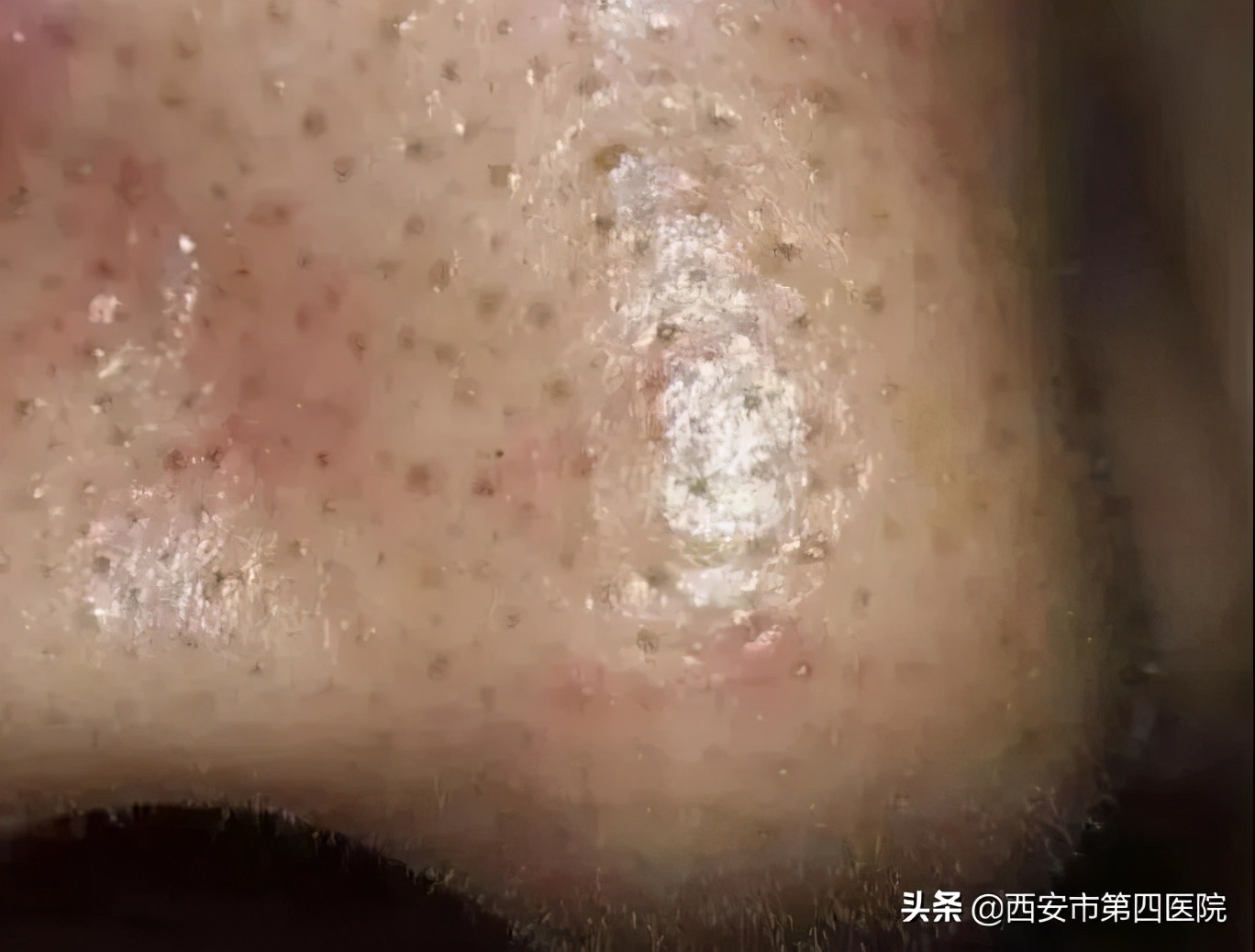 毛孔粗大的正确护肤方法,毛孔粗大正确护肤方法