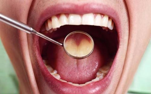 持续嘴苦是什么病的前兆,嘴里发苦是什么病的征兆