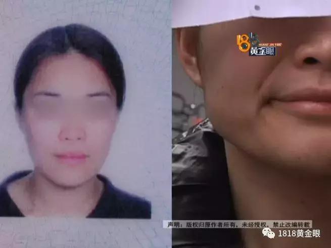 打完瘦脸针青蛙腮多久消失,打完瘦脸针出现哇噻是因为什么