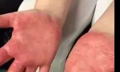 德州紧急提醒，孩子玩的“水晶泥”内含致命毒硼砂