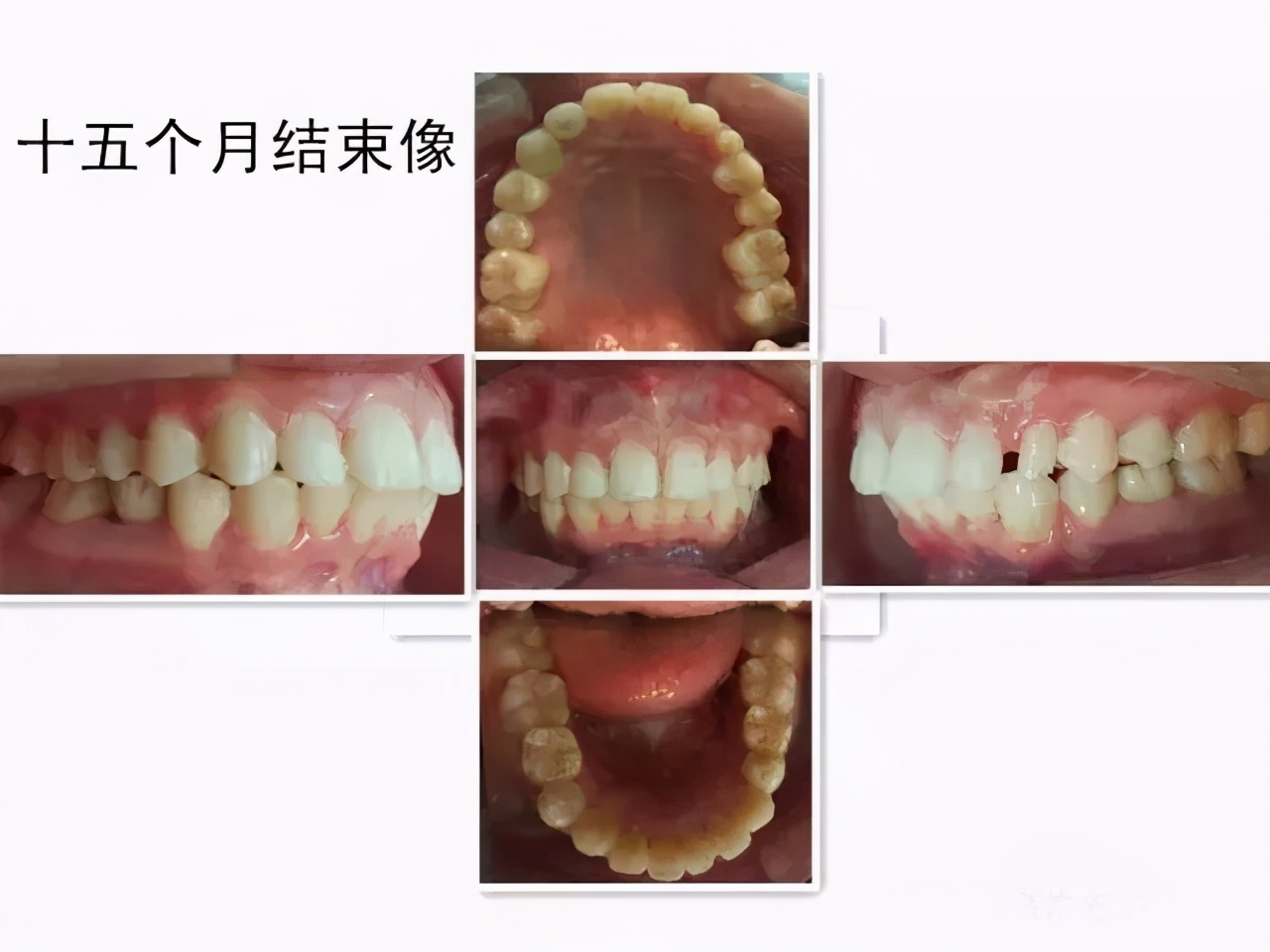成年人牙齿矫正戴上牙套嘴巴变凸,扩弓会使脸型变大吗