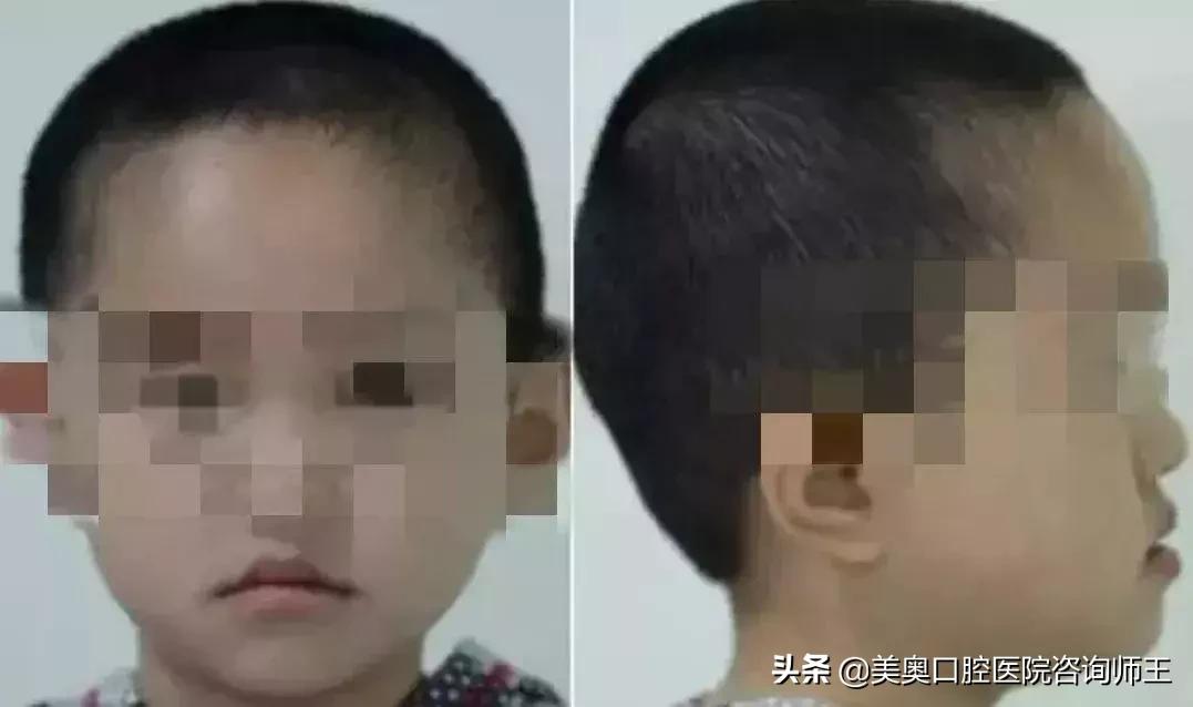 牙齿矫正地包天多久能看到效果,地包天越早矫正越好吗