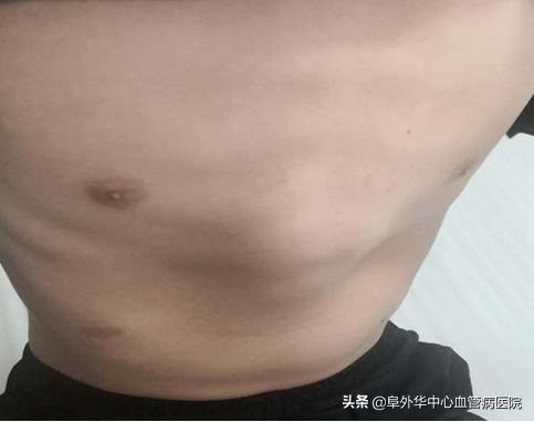 漏斗胸鸡胸矫正术,少年漏斗胸非手术治疗办法