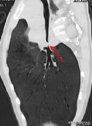 小儿气管镜怎么检查,小儿ct检查全过程视频