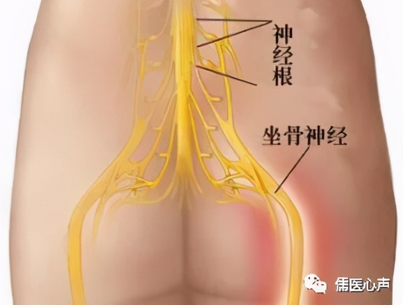 腰痛之捉妖记（十二）------腰痛？也许你得了“神经病”