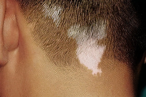 白癜风脱发脱得厉害怎么办,白癜风会导致头发脱落吗