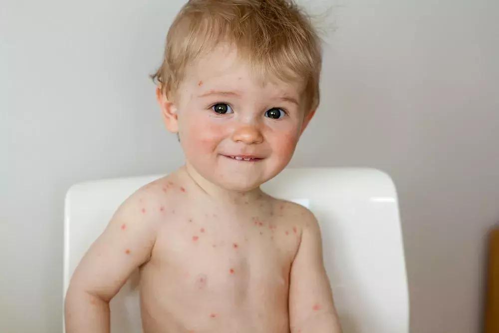 湿疹荨麻疹痱子的区别,痱子湿疹荨麻疹一起起该怎么办