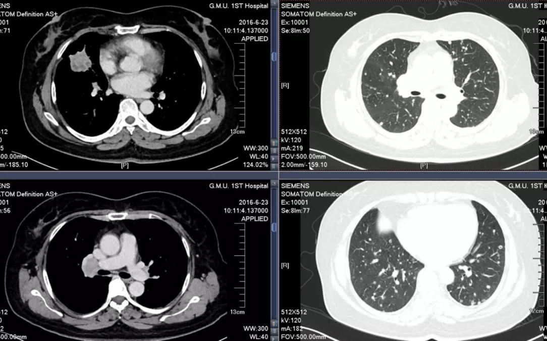 豪森药业阿美替尼治疗厄洛替尼经治T790M+肺腺癌伴脑转移病例分享