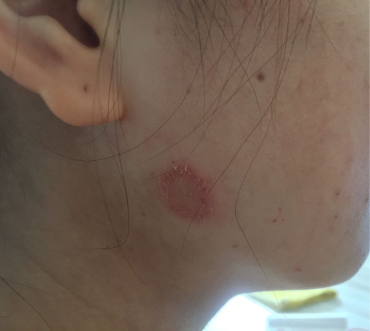 如何才能有效的治好猫癣,人得猫癣怎么治疗才可以根除