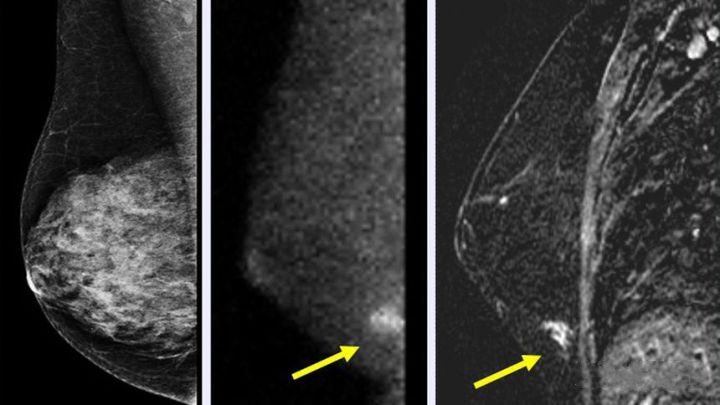 预防宫颈癌和乳腺癌的疫苗,预防乳腺癌宫颈癌的预防针多少钱