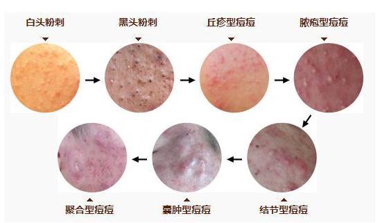 脸上的痘痘和粉刺的区别,女性常见的几种类型痘痘