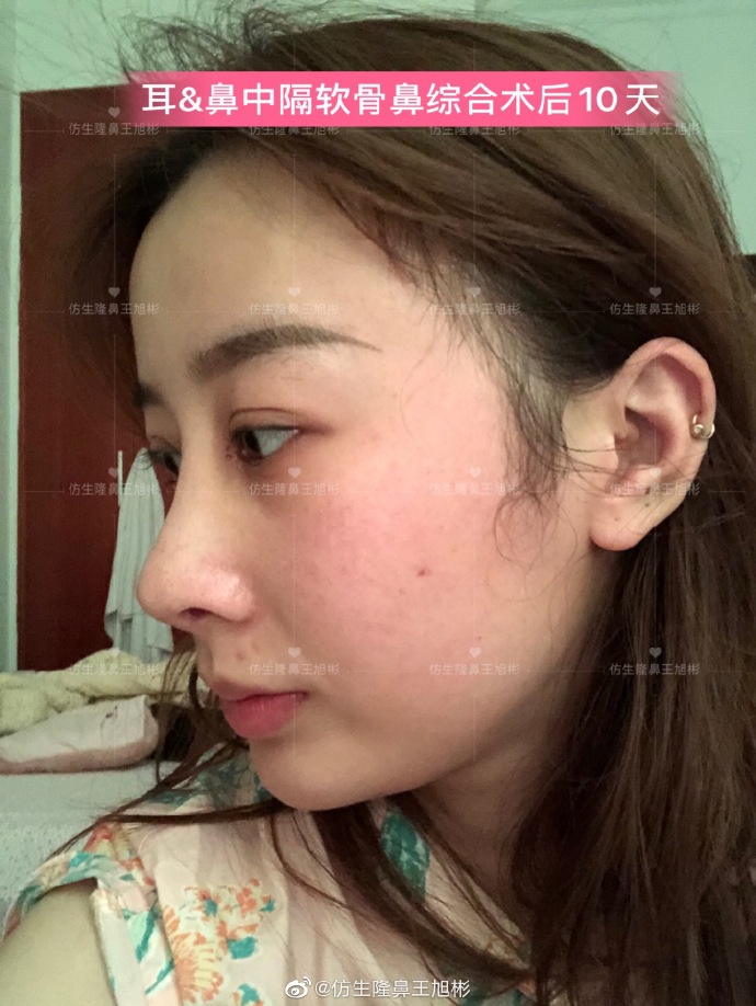 假体隆鼻耳软骨垫鼻尖图片,l型假体耳软骨隆鼻图片