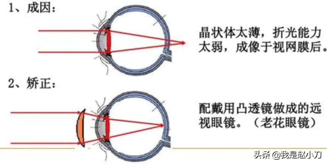 老花眼眼药水正确滴法,哪种眼药水适合老花眼